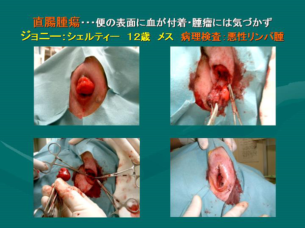 24.直腸腫瘍